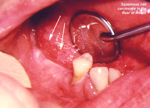ulcer on floor of mouth